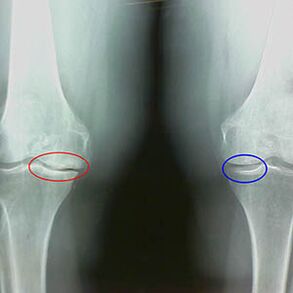 Arthrosis of the knee joint on the X -ray image
