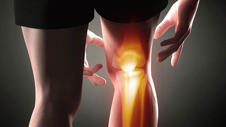 Arthrosis of the knee joint
