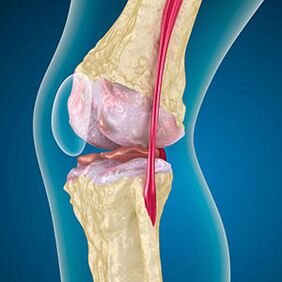 Excessive tension of the thigh muscle provokes the pain in the knee