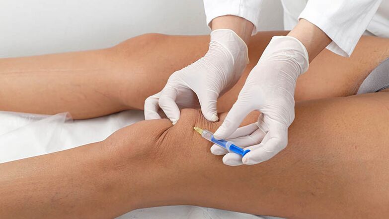 Intra -karticular injection to the arthrosis of the knee