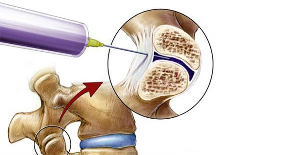 Paravertebral blockade for back pain